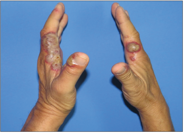 Acute erythematous pustular plaques on the hands triggered by driving