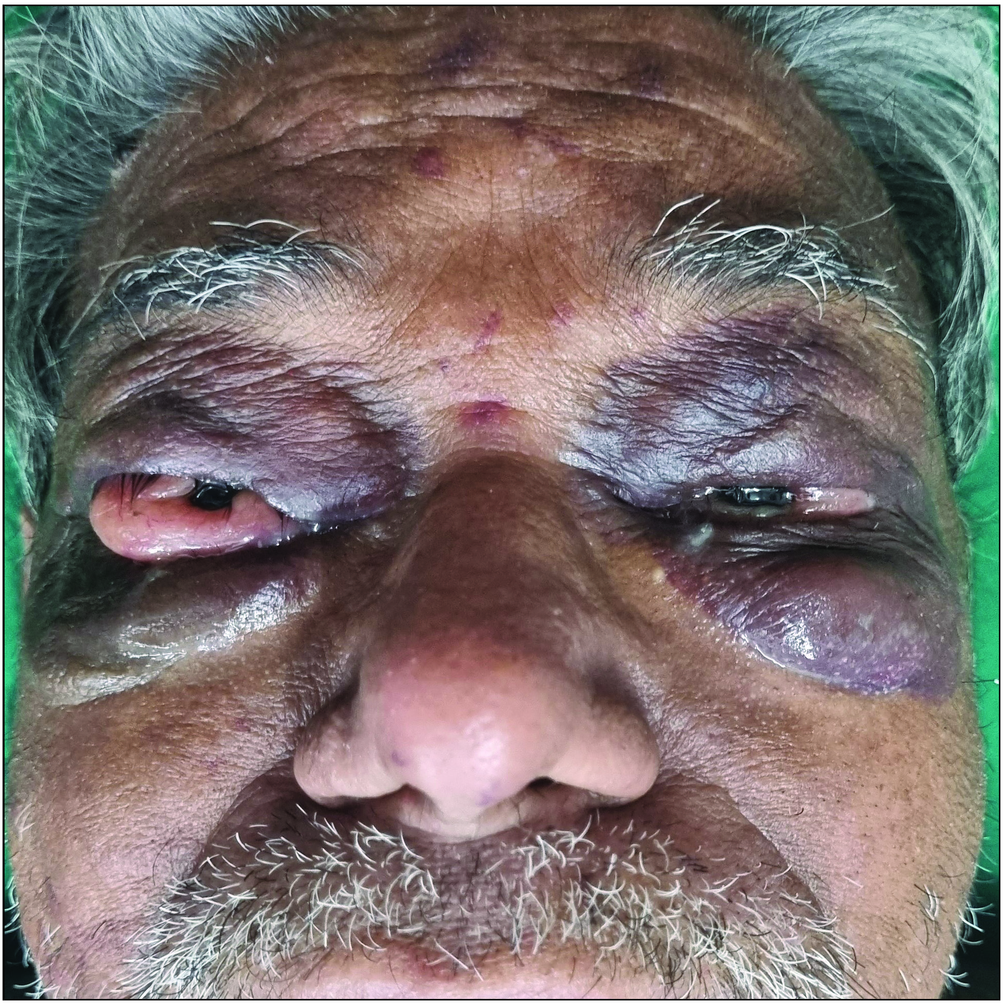 Spontaneous ecchymoses and conjunctival deposits in primary systemic amyloidosis