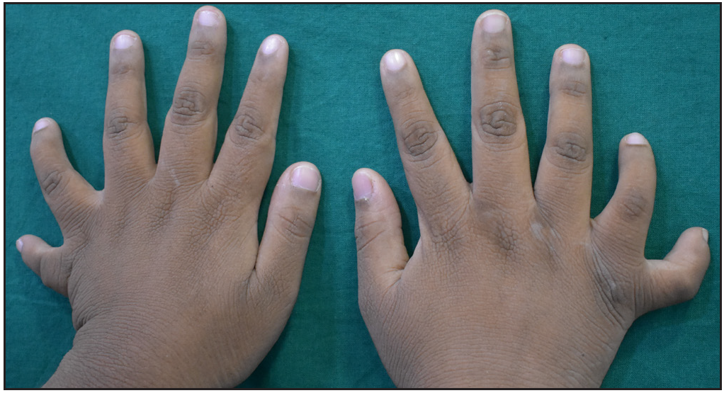 Bardet Biedl syndrome- A rare case