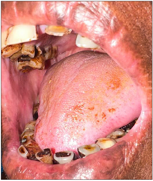 Signs and terminologies in cutaneous manifestations of substance abuse