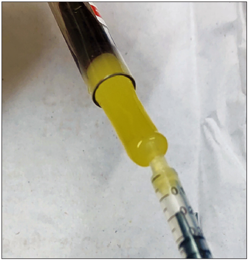 Using tuberculin syringe for withdrawing fibrin-plug in platelet-rich fibrin (PRF) therapy