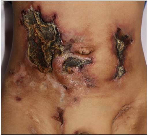 Lipodystrophia centrifugalis abdominals infantilis presenting as a giant ulceration and treatment with hydroxychloroquine and baricitinib