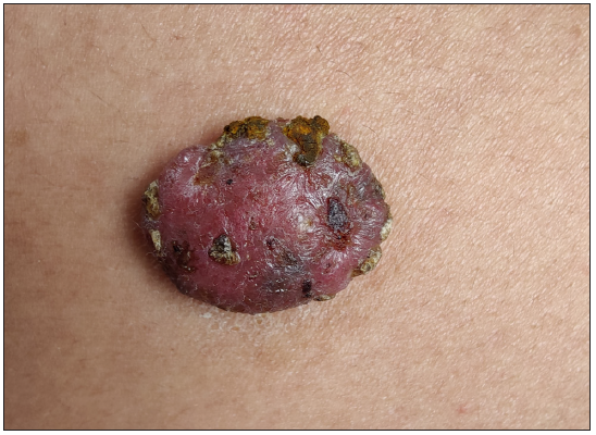 Eccrine poroma on the abdomen: A rare and atypical site