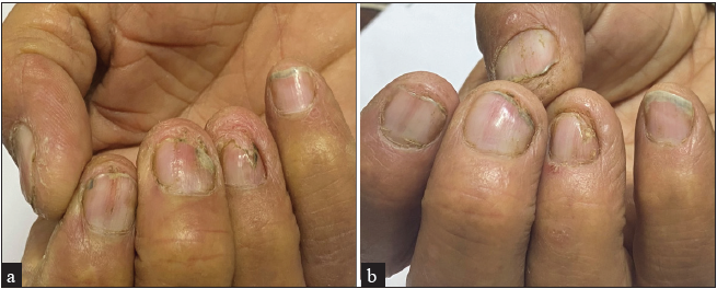 Intense pulsed light versus pulsed dye laser in the treatment of nail psoriasis: Intra-patient left to right comparative controlled study