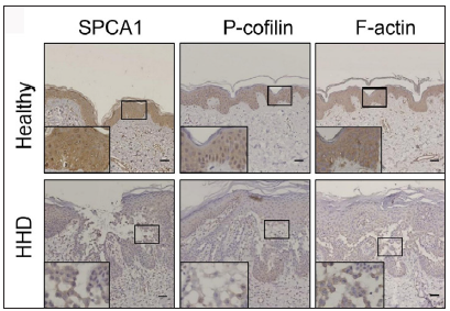 ATP2C1 knockdown induces abnormal expressions of cytoskeletal and tight junction proteins mimicking Hailey–Hailey disease