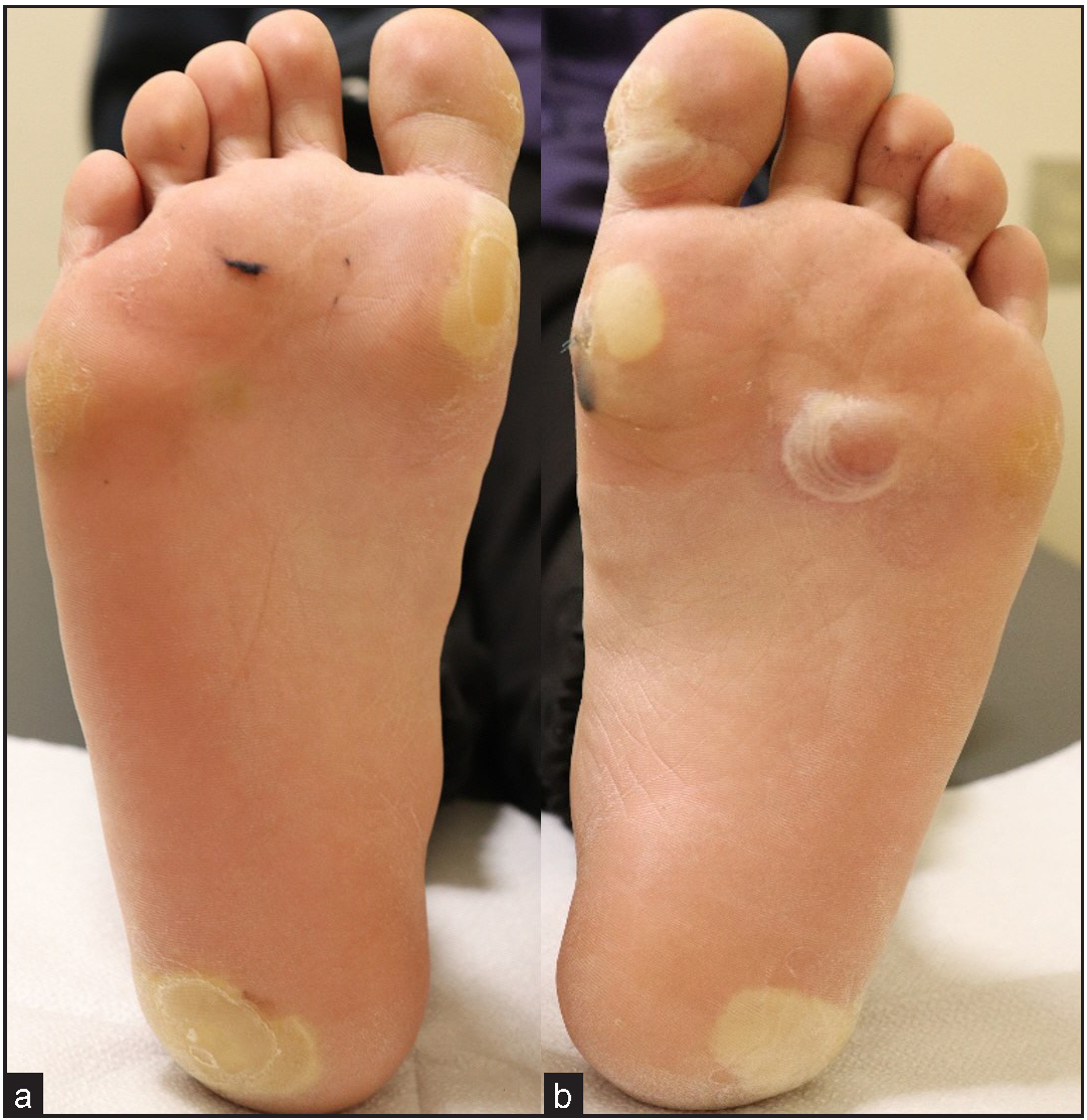 A case of the novel mutation p.L311P in KRT5 causing localised epidermolysis bullosa simplex in East Asian population