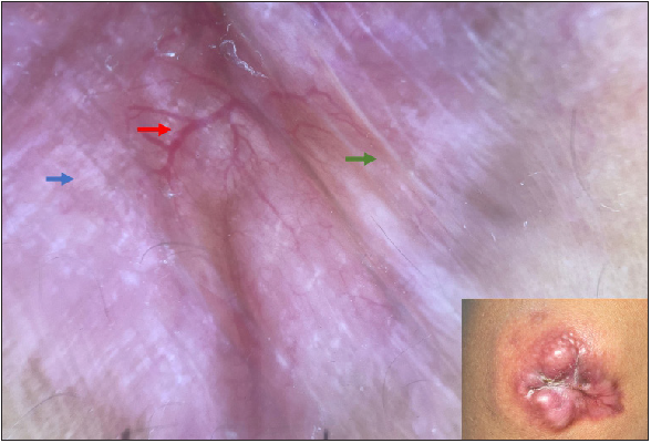 Dermoscopy of dermatofibrosarcoma protuberans in skin of colour: A study of four cases