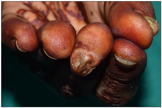 Subungual mass in a patient of xeroderma pigmentosum: Looking beyond malignant transformation