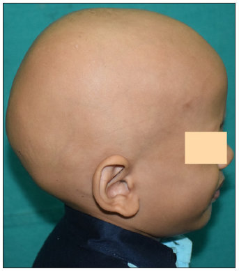 Systemic tofacitinib in paediatric alopecia areata