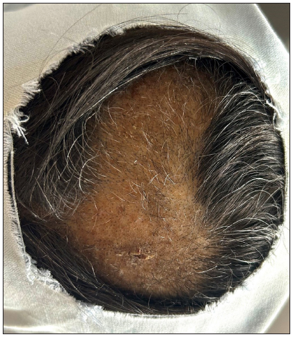 Lichen simplex chronicus of the scalp: A clinical and trichoscopic perspective