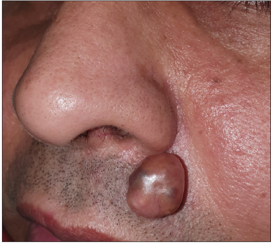 A pedunculated nodule over upper lip