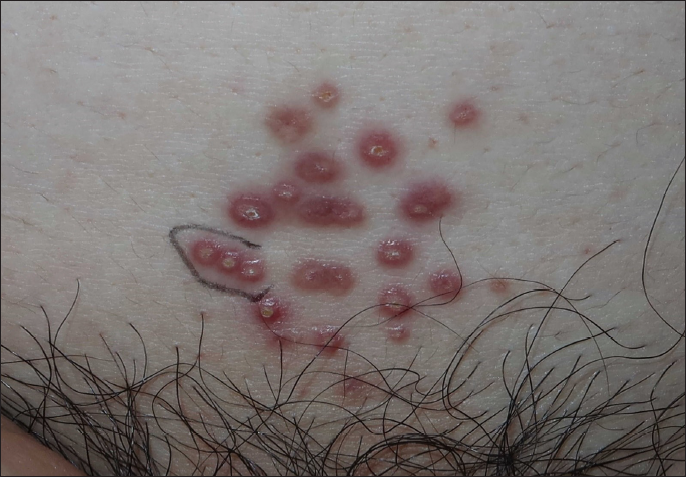 Cluster of papules with central pustule on the lower abdomen