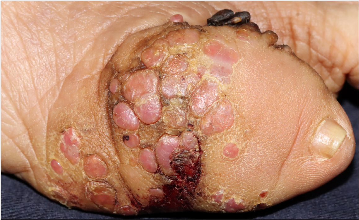 Primary cutaneous botryomycosis