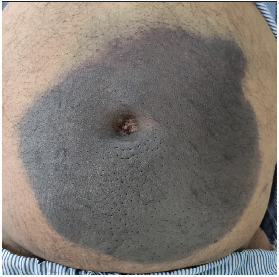 An unusual case of periumbilical discolouration – Cullen’s sign