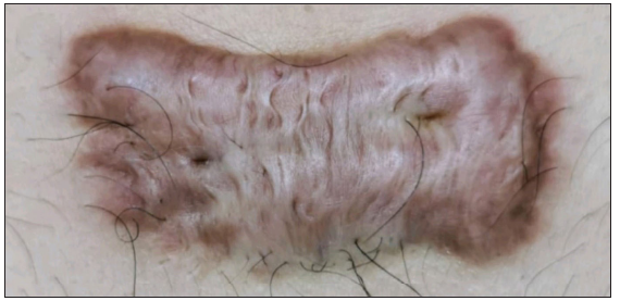 Radiofrequency-assisted fractional thermolysis for drug delivery in Keloids