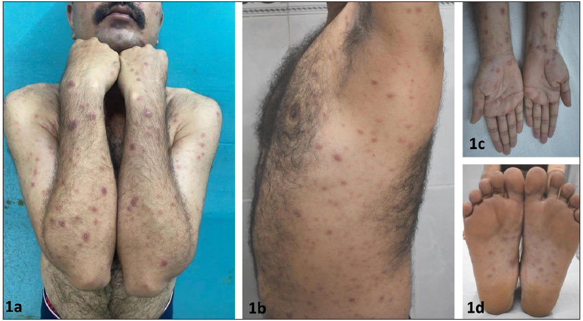 Dermoscopy aiding diagnosis of nodular granulomatous secondary syphilis