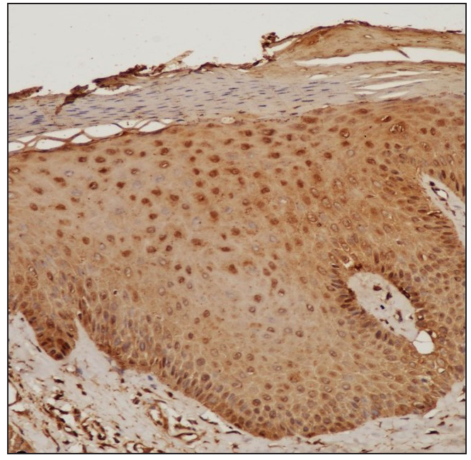 Translating tissue expression of STAT 1, 3 and 6 in prurigo nodularis to clinical efficacy of oral tofacitinib – A prospective single-arm investigational study