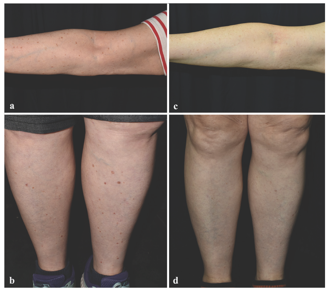 Topical egg yolk oil (4% cholesterol) and oral rosuvastatin for the treatment of disseminated superficial actinic porokeratosis