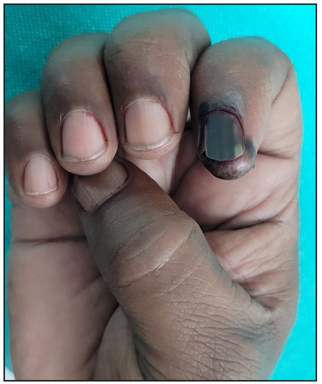 A curious case of solitary black nail