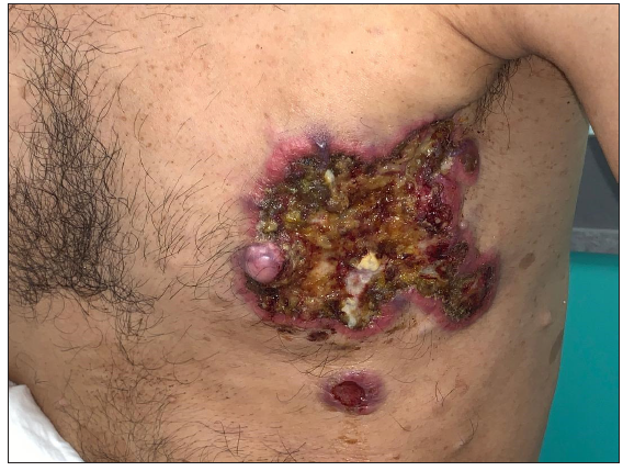 A rare case of breast cancer in a man with neurofibromatosis type 1