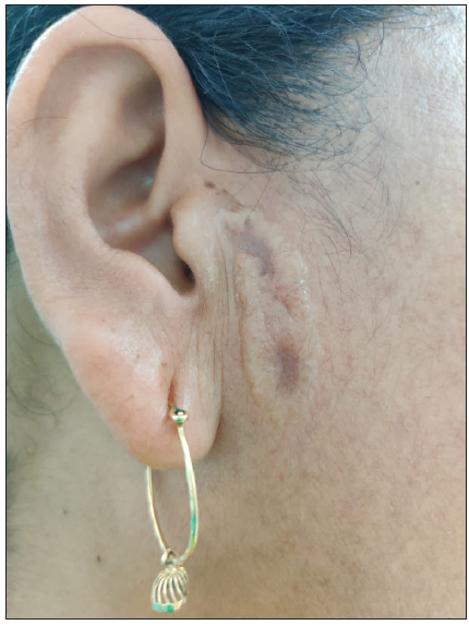 Skin coloured asymptomatic facial plaque in a woman