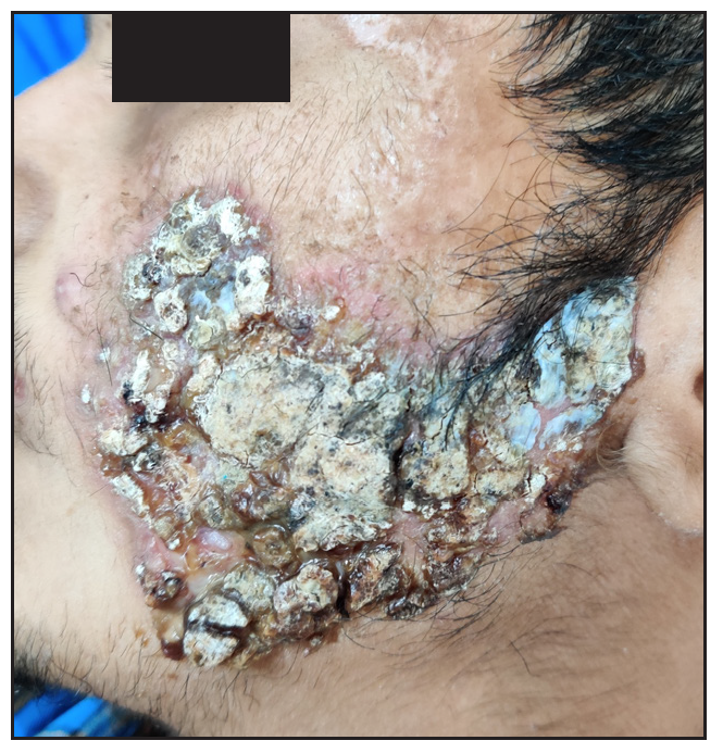 Synovitis, acne, pustulosis, hyperostosis, osteitis (SAPHO) syndrome with co-existing ulcerative and superficial granulomatous variants of pyoderma gangrenosum