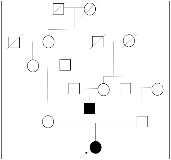 Compound heterozygosity in type-II oculocutaneous albinism