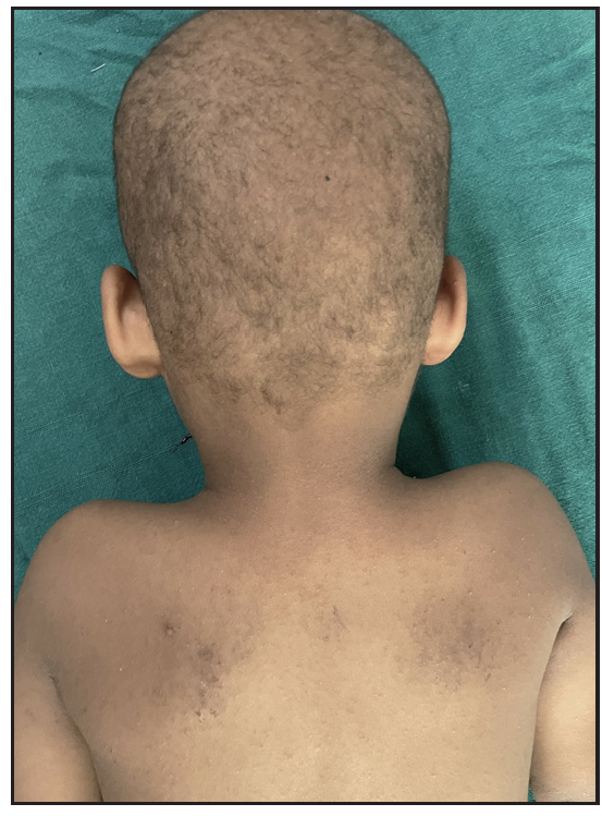 Trichothiodystrophy in two siblings and utility of polarised transilluminating dermoscopy in its diagnosis