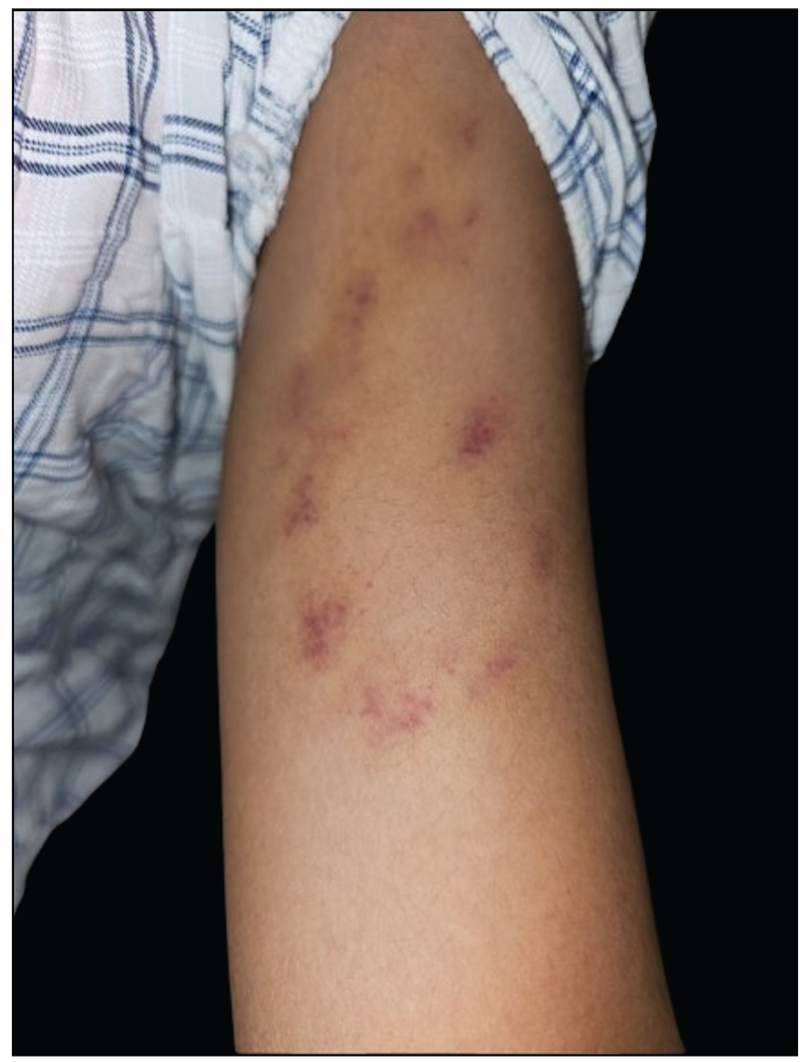 Gardner-Diamond syndrome: Psychogenic purpura with premenstrual flare