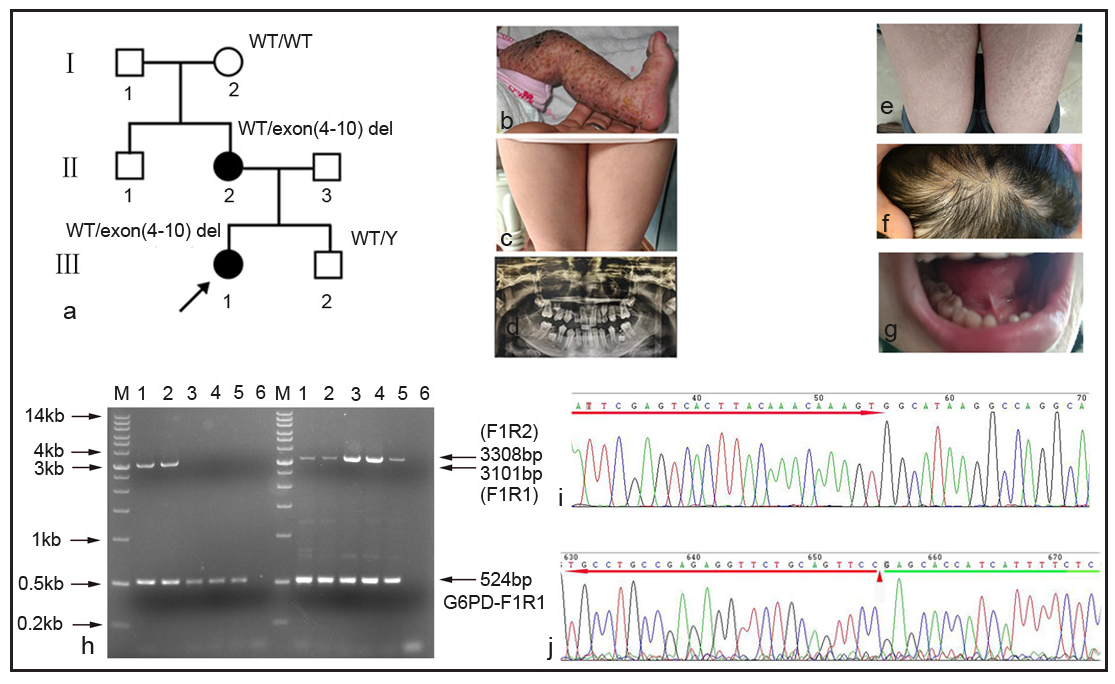 Detection of variants IKBKG exon4–10 del and c.1167dupC using a novel gene-specific gap-PCR and long accurate-PCR in two families with incontinentia pigmenti