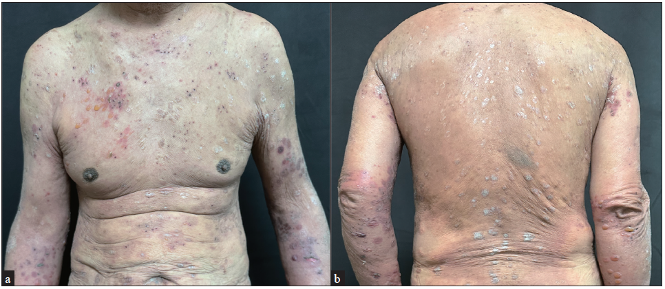 Combined biological therapy with dupilumab and secukinumab for coexisting bullous pemphigoid and psoriasis