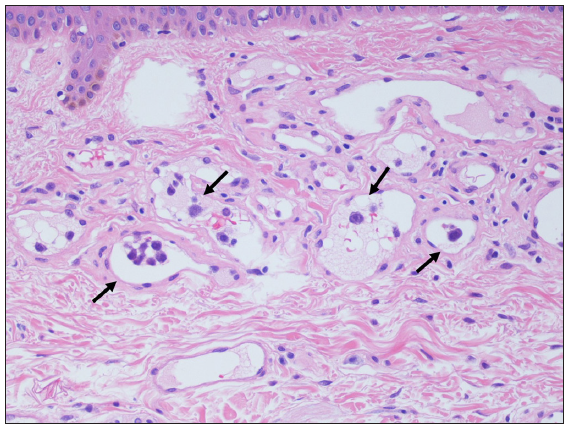 Association between final diagnosis and the levels of lactate dehydrogenase/soluble interleukin-2 receptor in the random skin biopsy-performed patients: A retrospective study of 50 cases