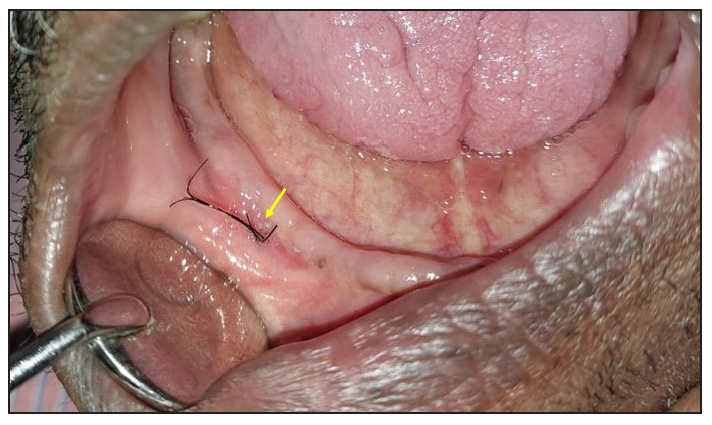 Orocutaneous fistula with oral mucosal hair growth: A rare presentation