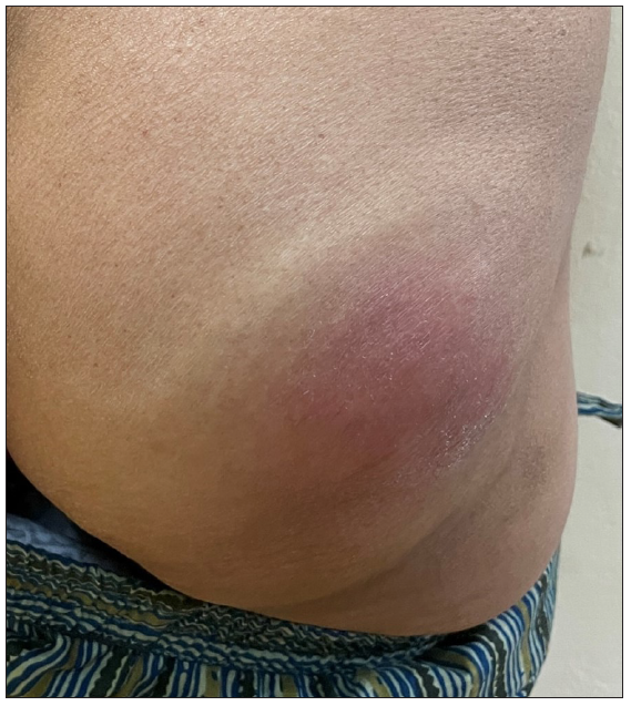 Cutaneous melioidosis presenting as multiple abscesses