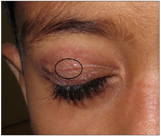 A case of eyelid capillary telangiectasia in juvenile clinically amyopathic dermatomyositis