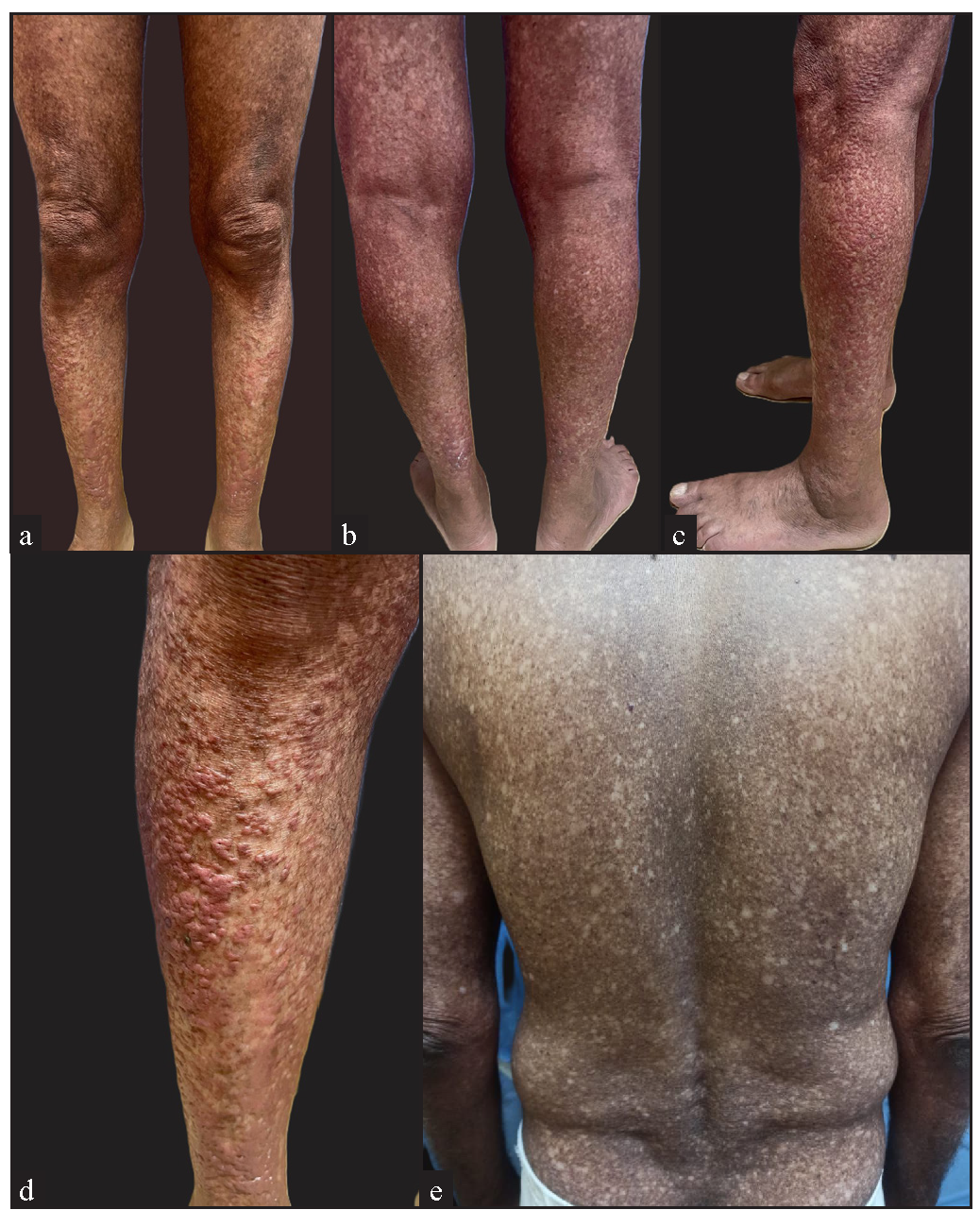 Eccrine syringofibroadenoma and amyloidosis cutis dyschromica: A new association