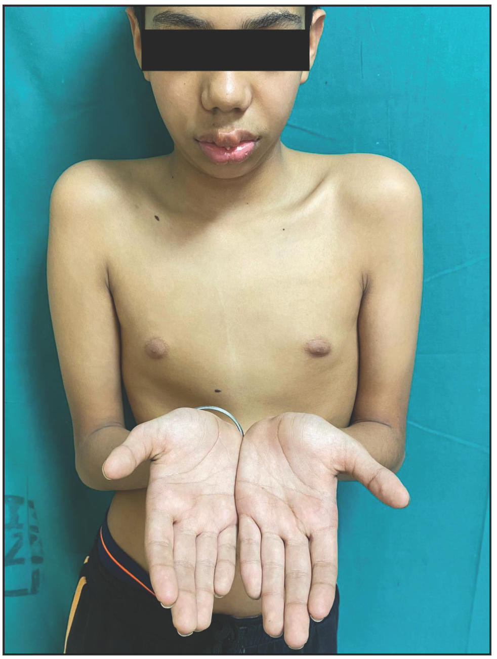 An adolescent boy with marfanoid habitus and macrocheilia