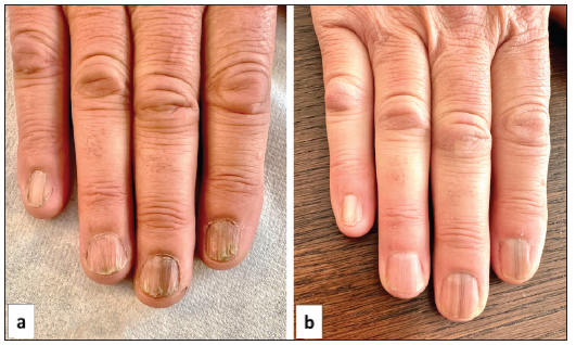 Efficacy of topical tofacitinib 2% cream in the treatment of nail lichen planus