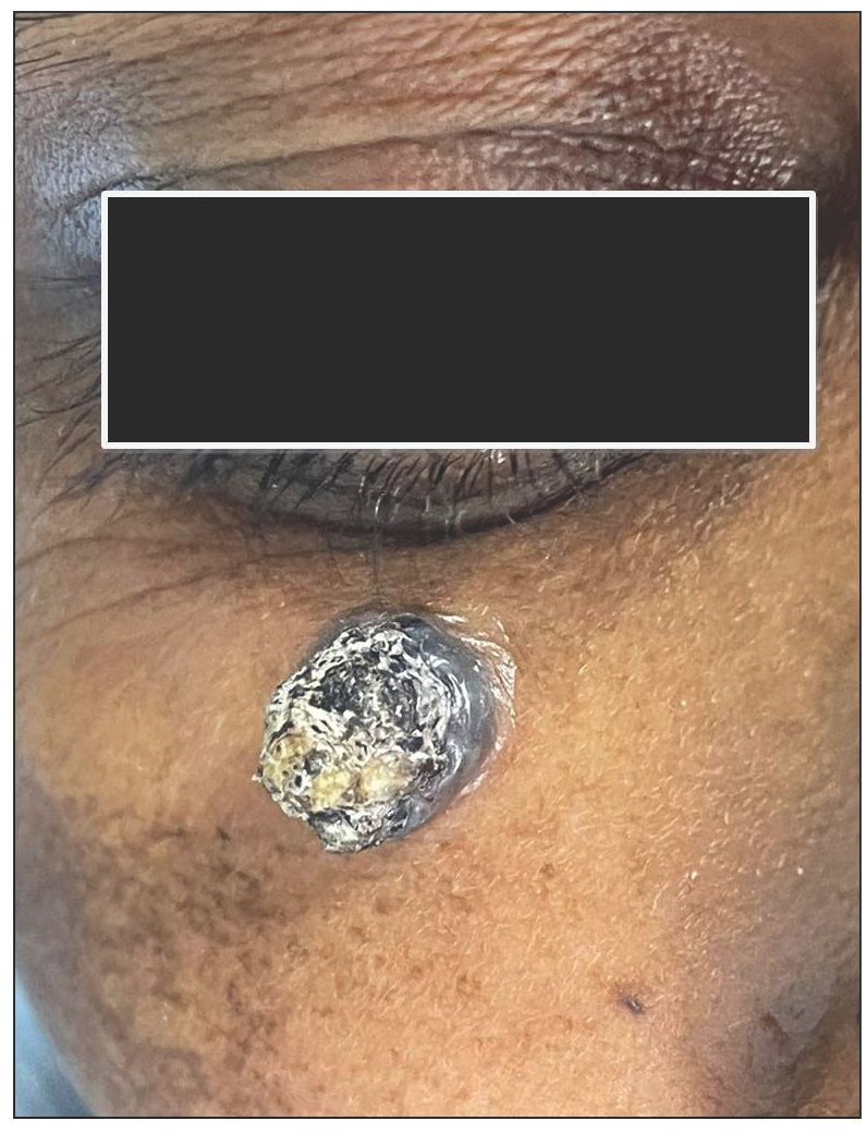 Pigmented nodular lesion below eyelid in a retro positive patient