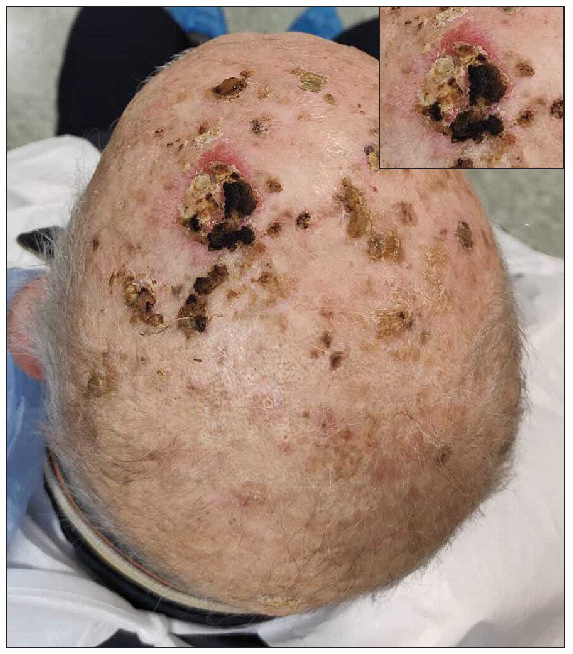 Atypical fibroxanthoma successfully treated with a single dose of cemiplimab