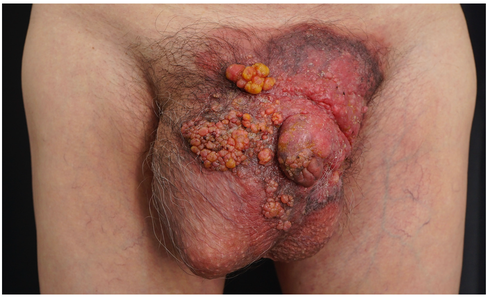 Invasive extramammary Paget’s disease presenting as scrotal nodules