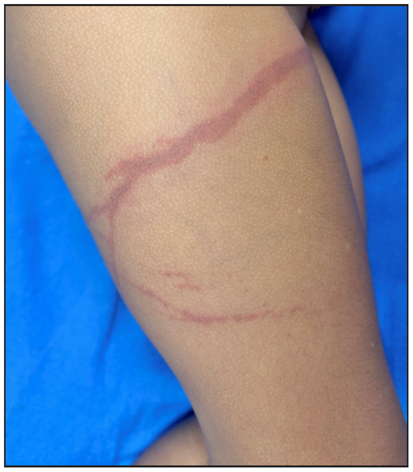 Immediate linear dermatitis caused by jellyfish sting