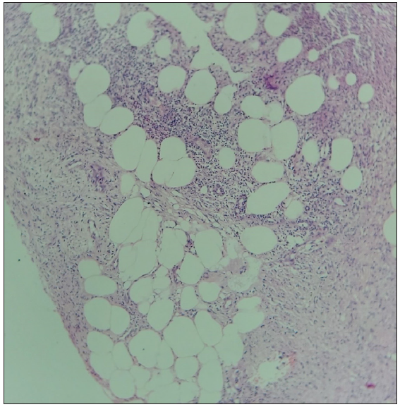 Clinical and immunological predictors of chronicity in erythema nodosum