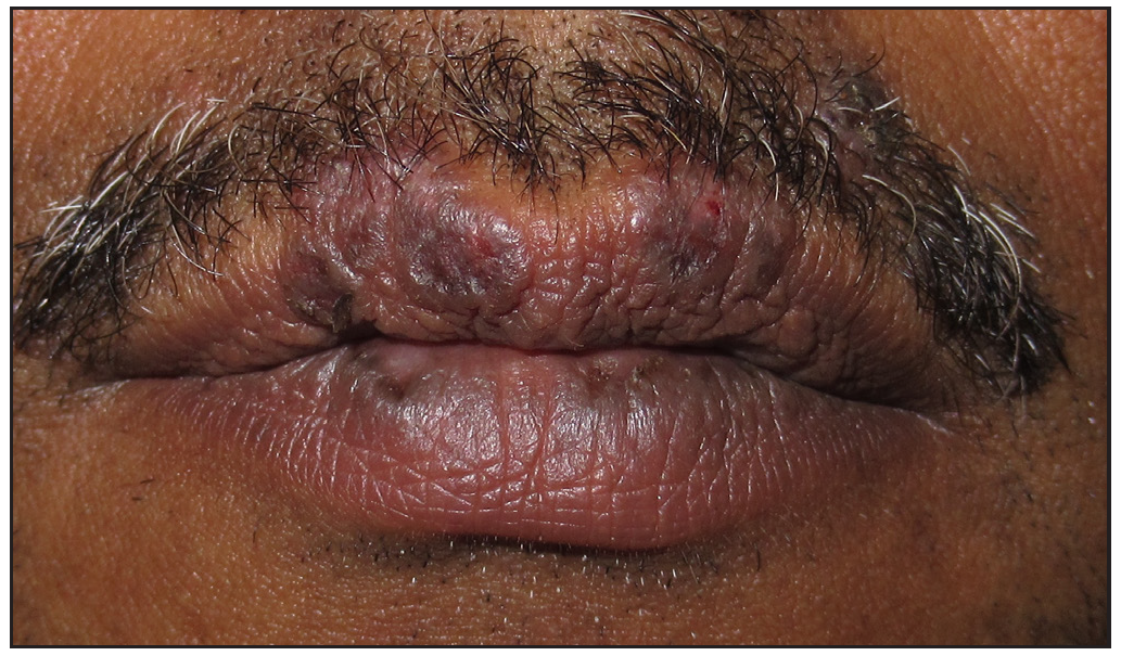 Non-eczematous lichenoid contact cheilitis: A rare presentation
