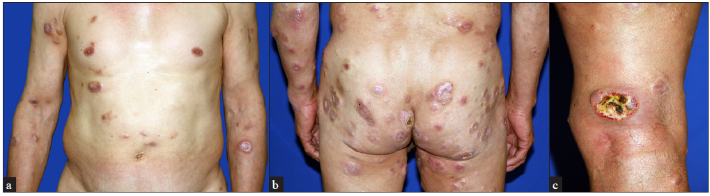 Generalised primary cutaneous anaplastic large cell lymphoma: A diagnostic challenge
