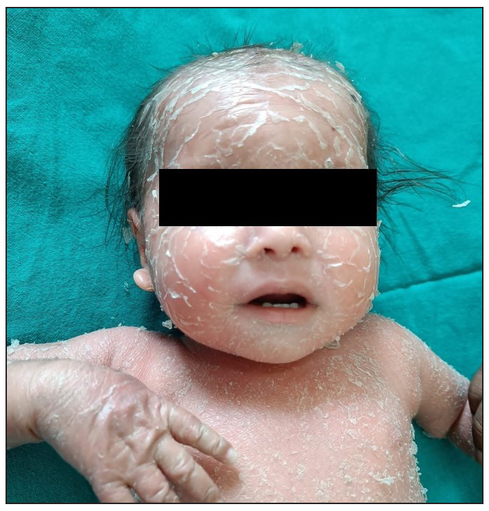 CARD14 associated papulosquamous eruption – A rare cause of erythroderma and successful management with secukinumab