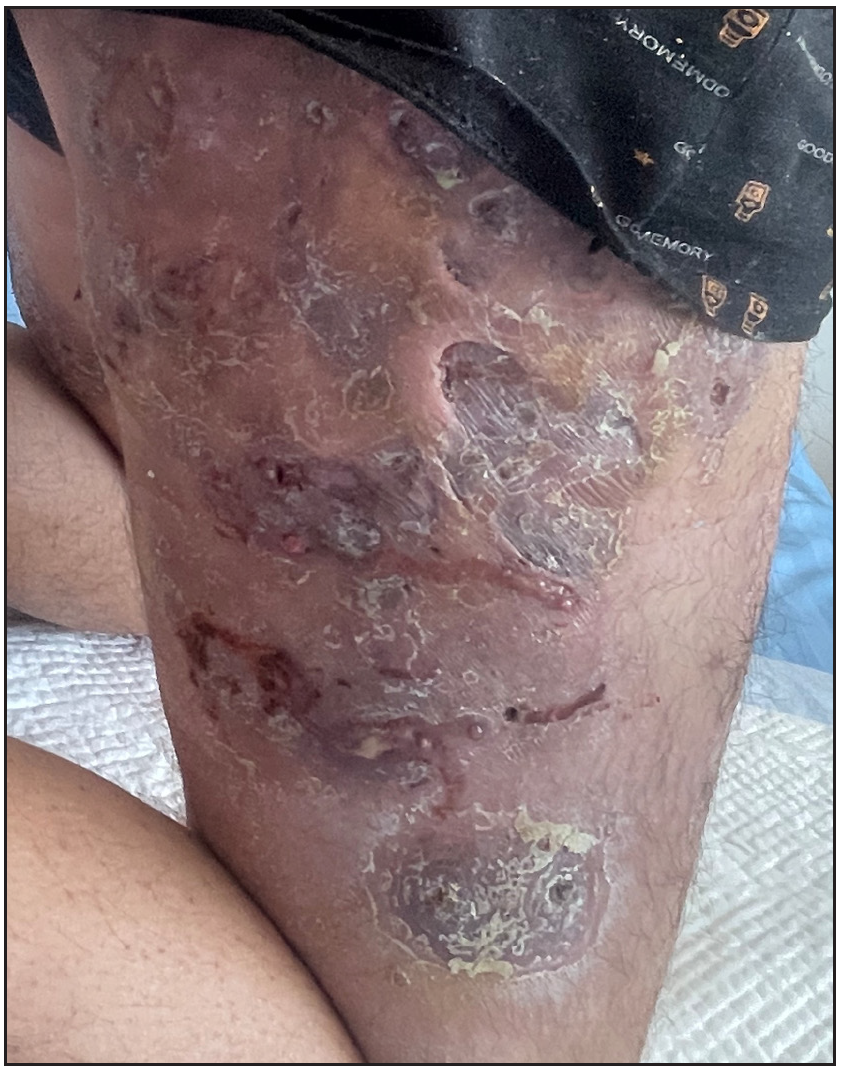 Spesolimab for treatment of severe hidradenitis suppurativa in the real world