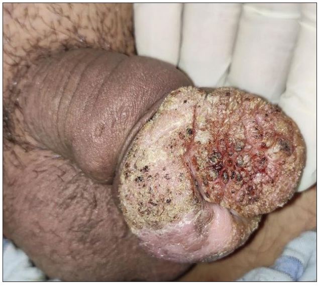 Verrucous growth on the glans penis: A clinical conundrum!