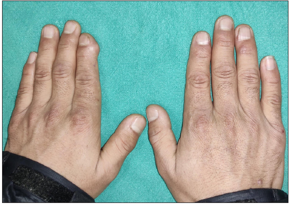 Asymptomatic digital swelling with nail changes- Multiple subungual osteochondromas