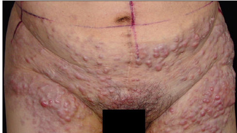 Cutaneous metastases from ovarian clear cell carcinoma